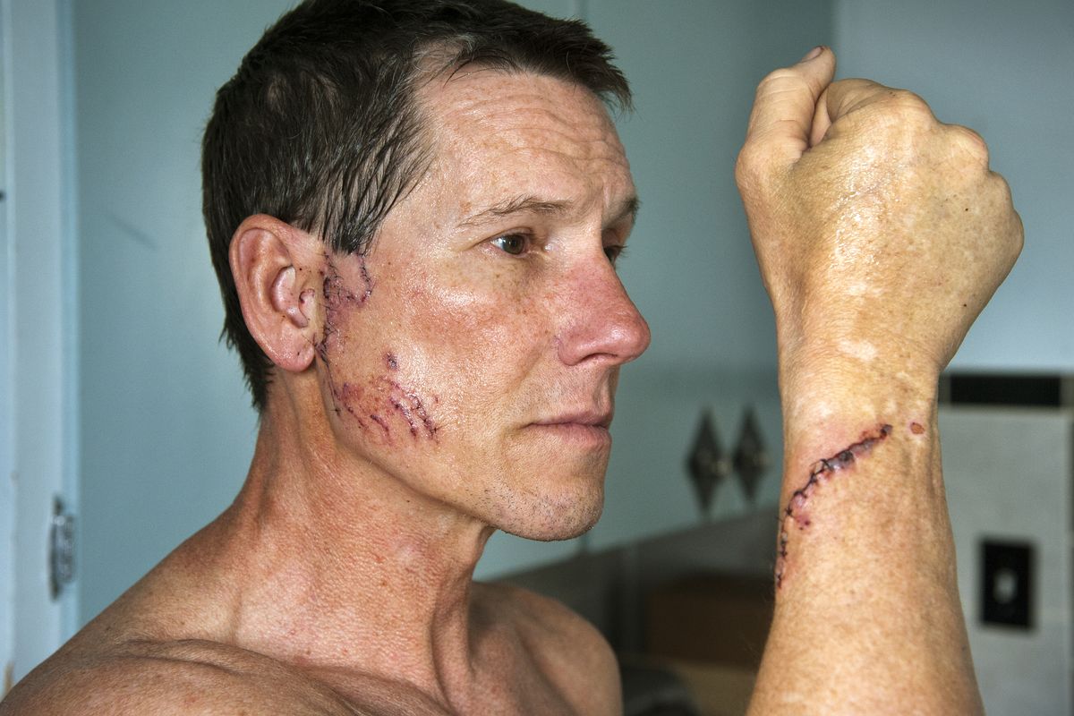 Craig Randleman, 50, suffered dog bites requiring 40 stitches on his wrist, ear and bicep area, along with a swollen hand, after beating off a pit bull that was mauling a 8-year-old girl on April 3, 2014, in northeast Spokane, Wash.  Randleman heard the screams and rushed down his alley to render assistance. (Dan Pelle / The Spokesman-Review)