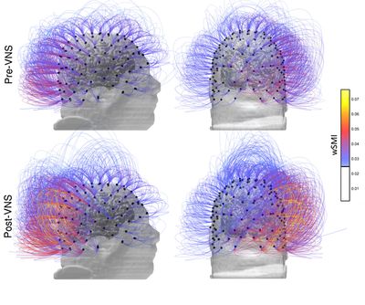 This image provided by the CNRS Marc Jeannerod Institute of Cognitive Science in Lyon, France, shows brain activity in a patient before, top row, and after vagus nerve stimulation. Warmer colors indicate an increase of connectivity. In a report published Monday, Sept. 25, 2017, French doctors say they restored some signs of consciousness in a brain-injured man who hadn’t shown any awareness in 15 years. (CNRS Marc Jeannerod Institute of Cognitive Science / Associated Press)