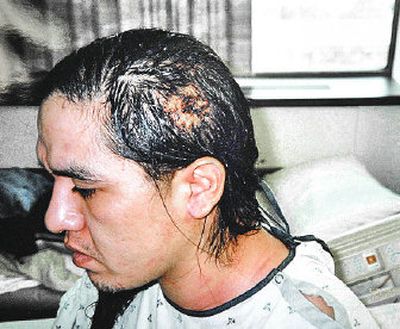 
Shonto Pete is seen with a gunshot wound to the head he received on Feb. 26.
 (The Spokesman-Review)