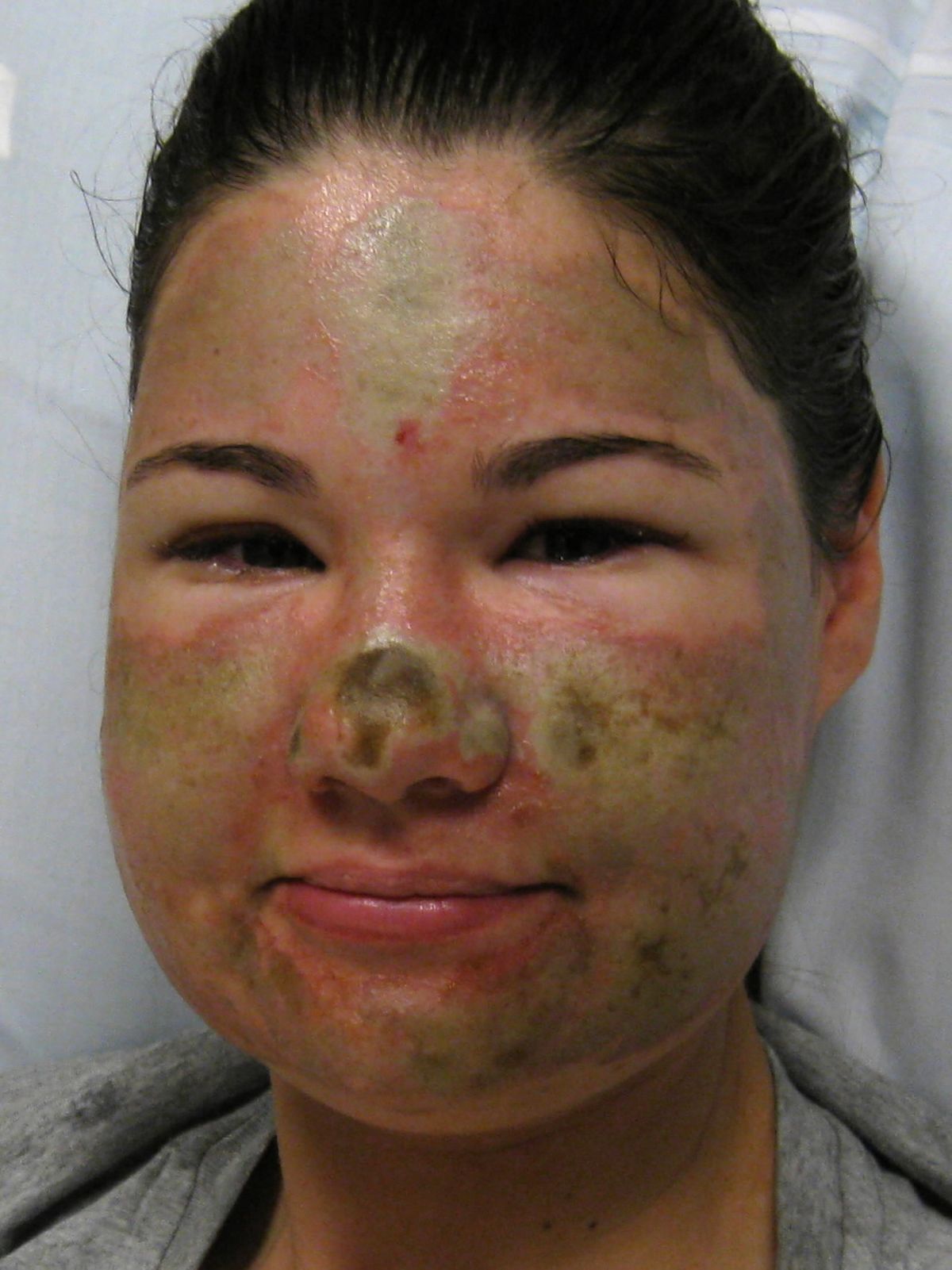 This image provided by the Legacy Emanuel Medical Center shows Bethany Storro prior to surgery in Portland. (Legacy Emanuel Medical Center)