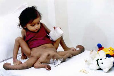 
Lakshmi, 2, was born with four arms and four legs.Associated Press
 (Associated Press / The Spokesman-Review)