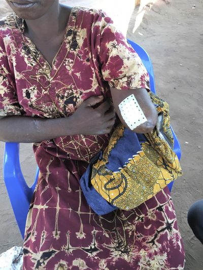 Undated photo provided by OHCHR in Geneva, shows a woman with amputated arm in the province Lunda Norte, Angola in June 2017. (AP)