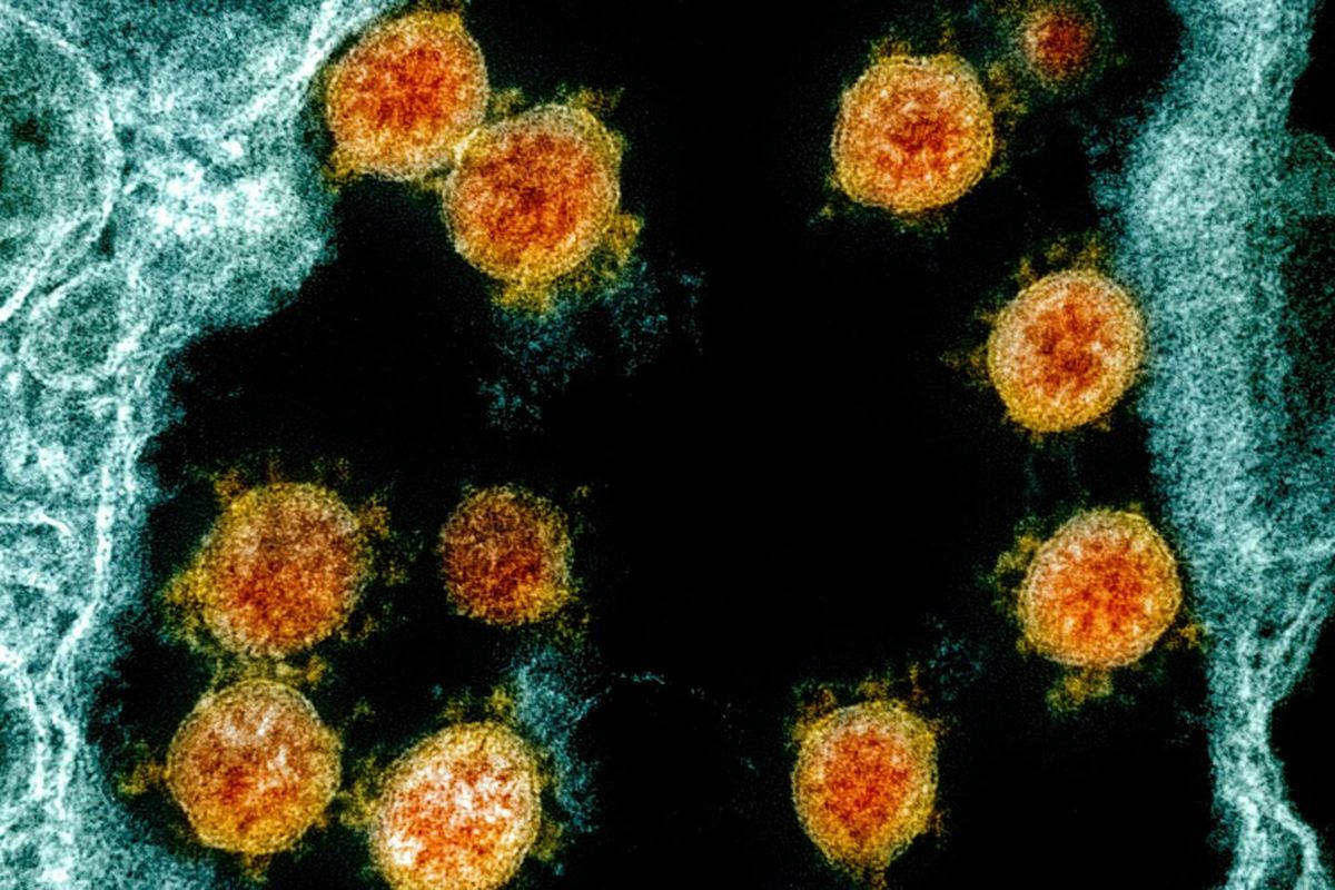 This electron microscope image made available and color-enhanced by the National Institute of Allergy and Infectious Diseases Integrated Research Facility in Fort Detrick, Md., shows Novel Coronavirus SARS-CoV-2 virus particles, orange, isolated from a patient. University of Hong Kong scientists claim to have the first evidence of someone being reinfected with the virus that causes COVID-19.   (HOGP)