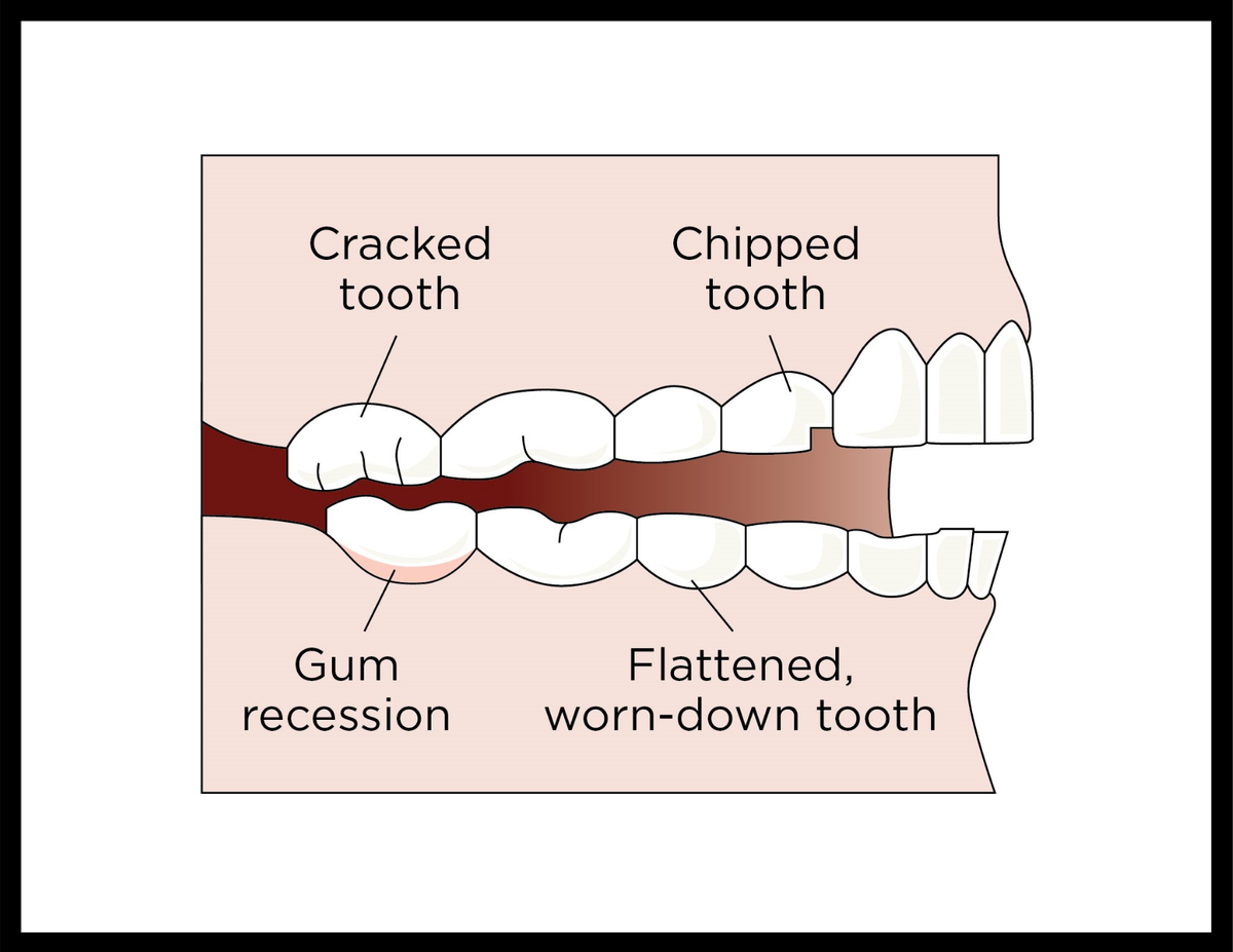 Cracked Teeth Seattle WA