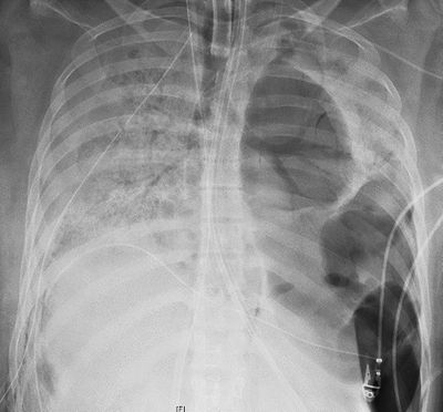 This X-ray image provided by Northwestern Medicine in June 2020 shows the chest of a COVID-19 patient before she received a new set of lungs because of severe lung damage from the coronavirus, at Northwestern Memorial Hospital in Chicago.  (HONS)