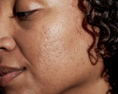 Dermatologists say it’s common to get acne in your 30s, 40s and beyond – even if you never had breakouts as a teen.  (New York Times)