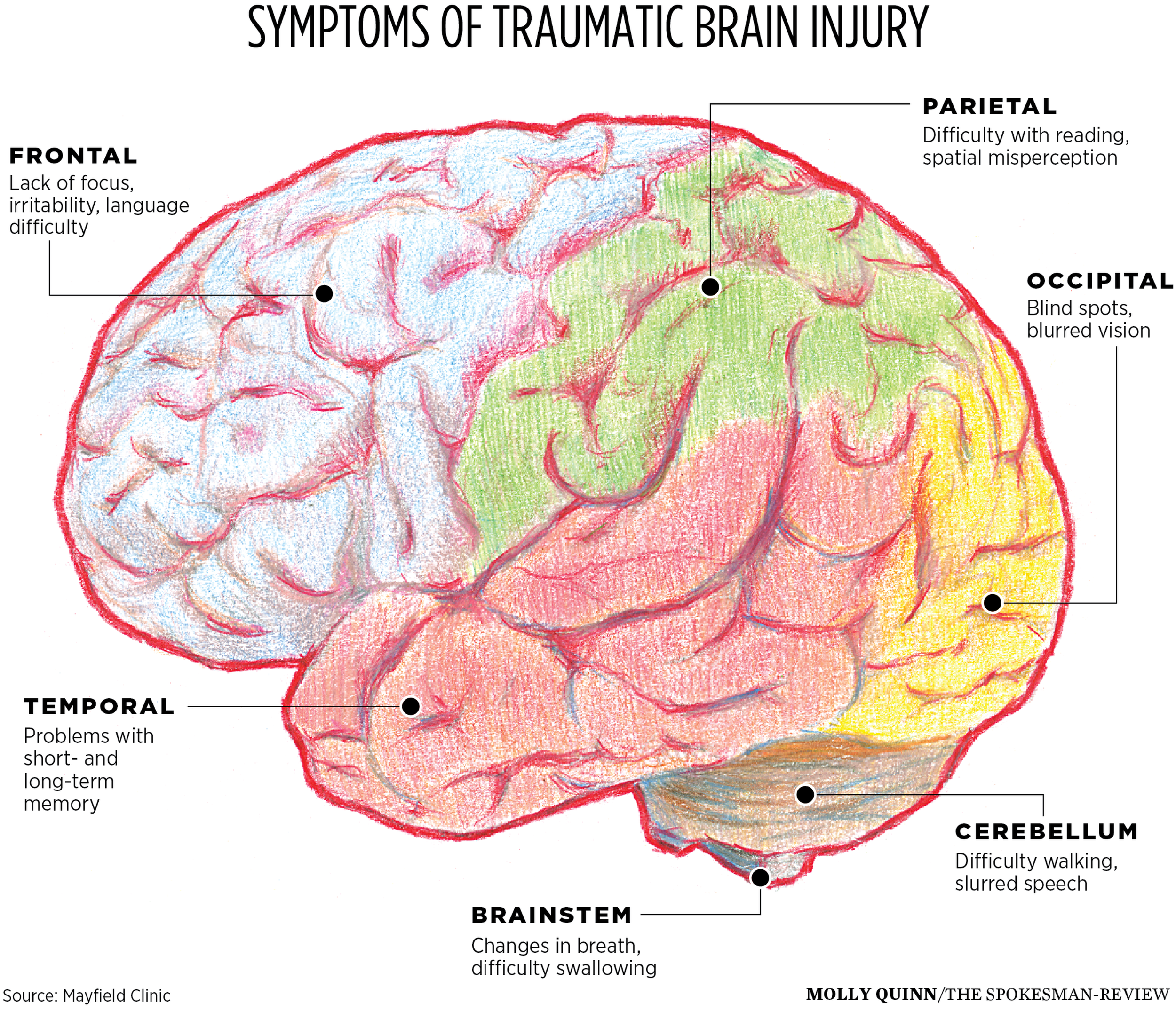 Traumatic brain. TBI.