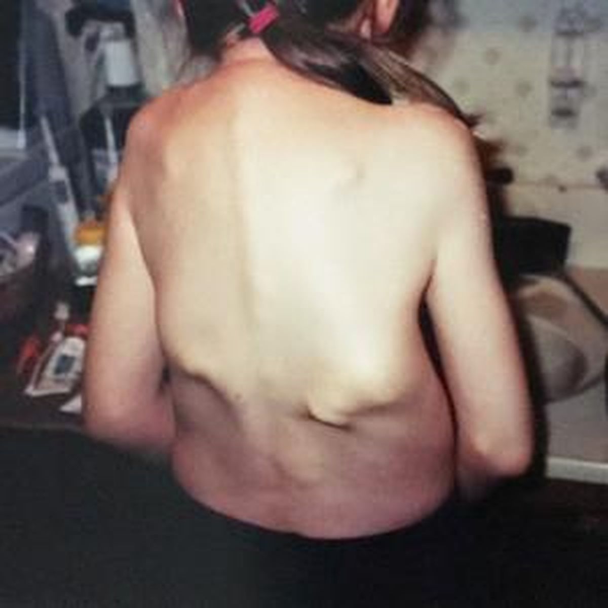 Jasmin Floyd as a child; by the time she was 7 or so, Floyd said, her shoulders had started sticking; gradually, she found herself unable to rotate them. . (Courtesy photo / Jasmin Floyd)