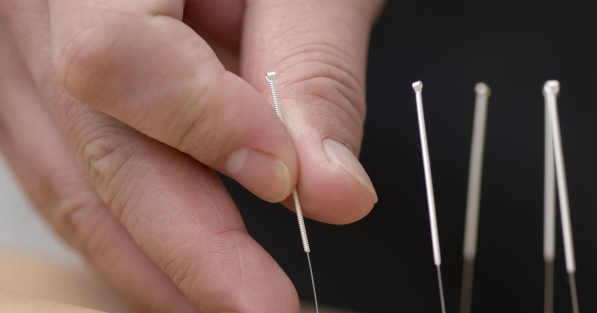 On pins and needles Millions choose acupuncture for relief The