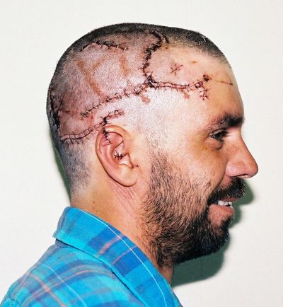 After a 1992 grizzly bear attack, Terry Everard lost four units of blood and needed 250 stitches.