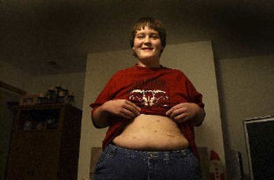 
Bob Plumb, 15, proudly shows his scars from stomach surgery performed in Mexico to curb his desire to eat. Since the surgery in October, he has lost 47 pounds. 
 (Brian Plonka / The Spokesman-Review)