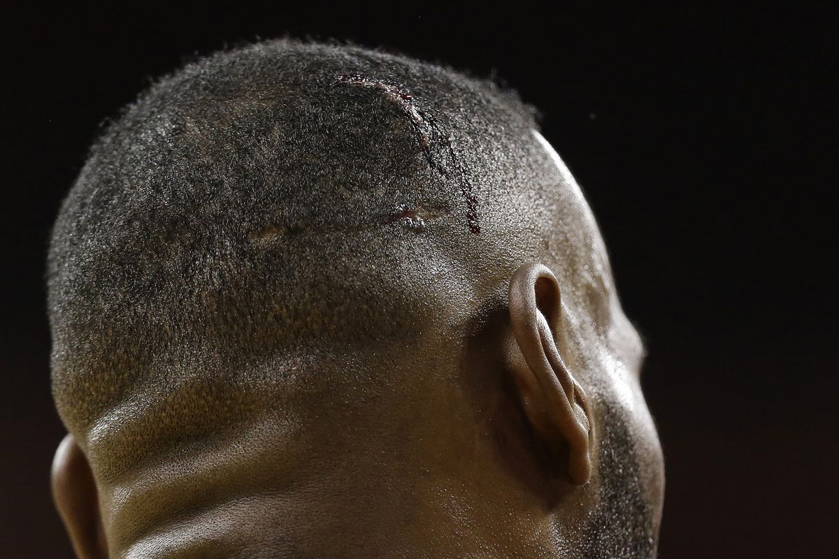 A wound is seen on the head Cleveland Cavaliers forward LeBron James during the second half of Game 4 on Thursday. (AP)