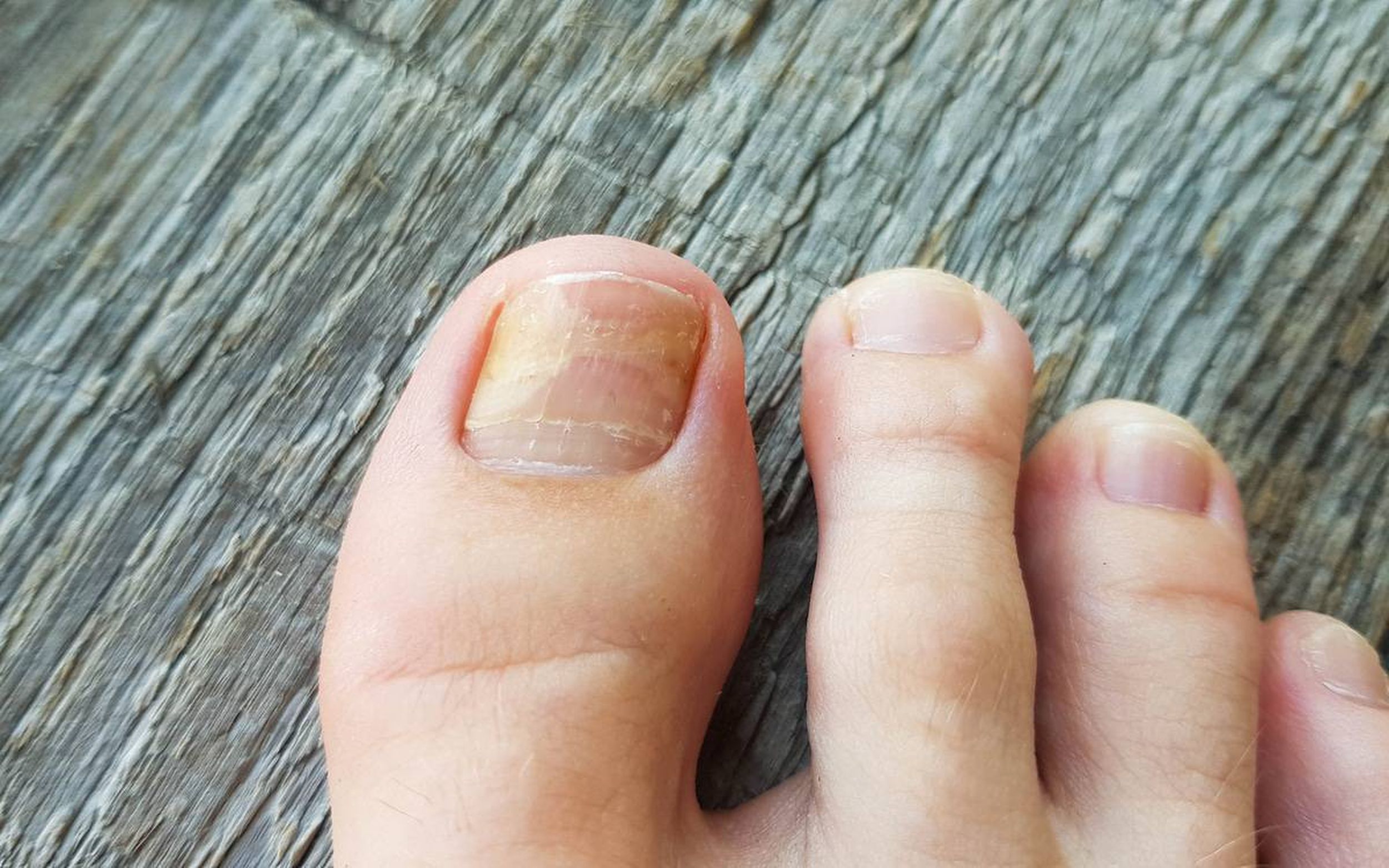 Neosporin for Nail Fungus