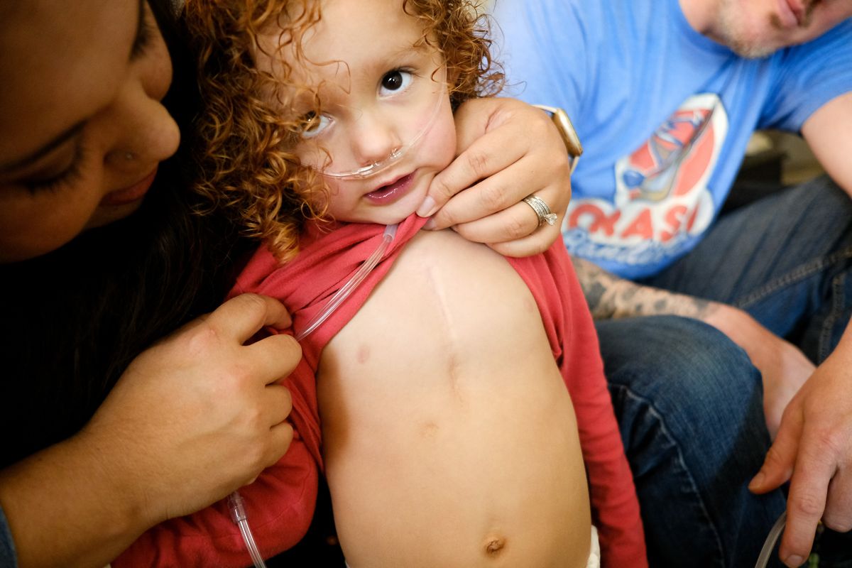 Graycen Pruett’s mother Jaclyn, left, pulls his shirt up to show the vertical scar on his chest from heart surgeries. Graycen Pruett will undergo his third heart surgery this summer because of congenital heart disease.  (Tyler Tjomsland/The Spokesman-Review)