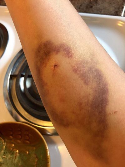 Heather Rose Clarkes arm shows bite marks and bruising one week after she was attacked by a squirrel while walking in Manito Park. (Heather Rose Clarke / COURTESY PHOTO)