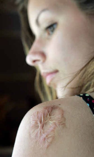 
High school freshman Leslie Meigs shows scarring on her left arm Tuesday from a case of meningitis that nearly killed her when she was 8. 
 (Associated Press / The Spokesman-Review)