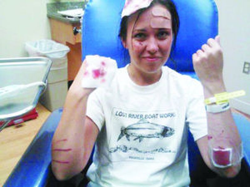 Sydney Sainsbury suffered a broken bone and torn ligaments and tendons in her right hand, along with many bites and scratches from an otter attack July 9 while floating the Madison River. (Courtesy of Sydney Sainsbury)