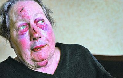 Alvena E. Eales, 81, describes on Thursday how she was mugged in Riverfront Park. The Olympia resident suffered a broken nose, scrapes and bruises when a man stole her purse and pushed her to the ground Wednesday morning.
(Holly Pickett / The Spokesman-Review)