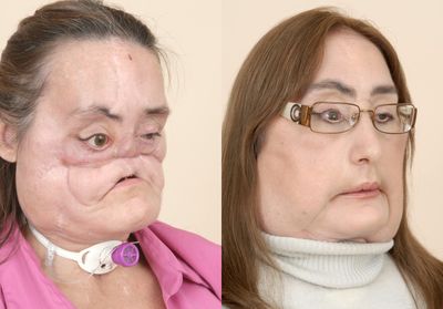 This photo, supplied by the Cleveland Clinic, shows Connie Culp after a gunshot injury, left, and then as she appears today after a face transplant. (Associated Press / The Spokesman-Review)