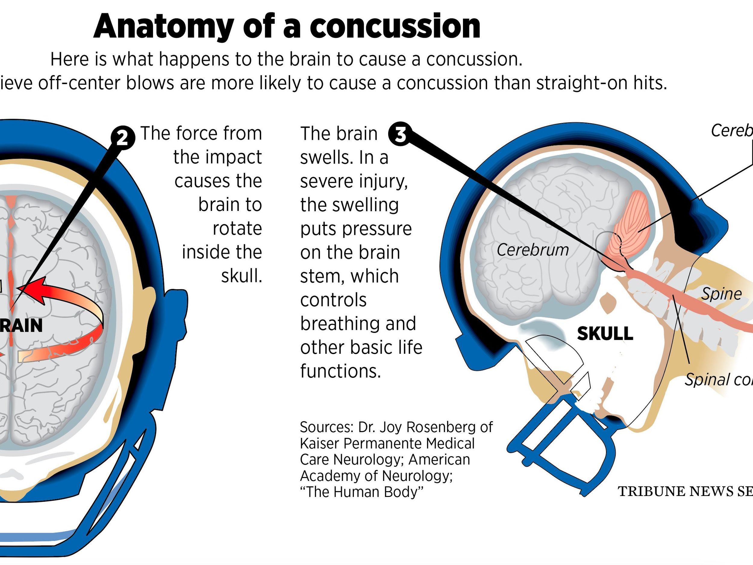 Sports-related concussions not proved to cause later brain disease, says  expert group, Science