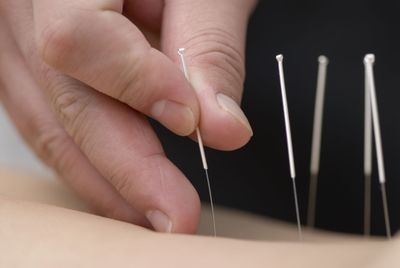 Acupuncture, the  Chinese practice of healing through the insertion of needles into specific points on the body, has been part of mainstream America for more than 30 years.  Stock Expert (Stock Expert / The Spokesman-Review)