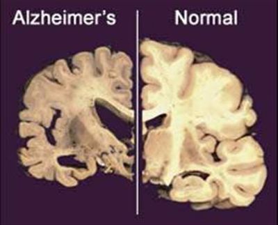 This undated image provided by Merck & Co., shows a cross section of a normal brain (right) and one of a brain damaged by advanced Alzheimer's disease. Alzheimer's patients and their families, desperate for an effective treatment for the epidemic disease, there's hope from new studies starting up and insights from recent ones that didn't quite pan out. (/) (AP Photo / Merck & Co.)