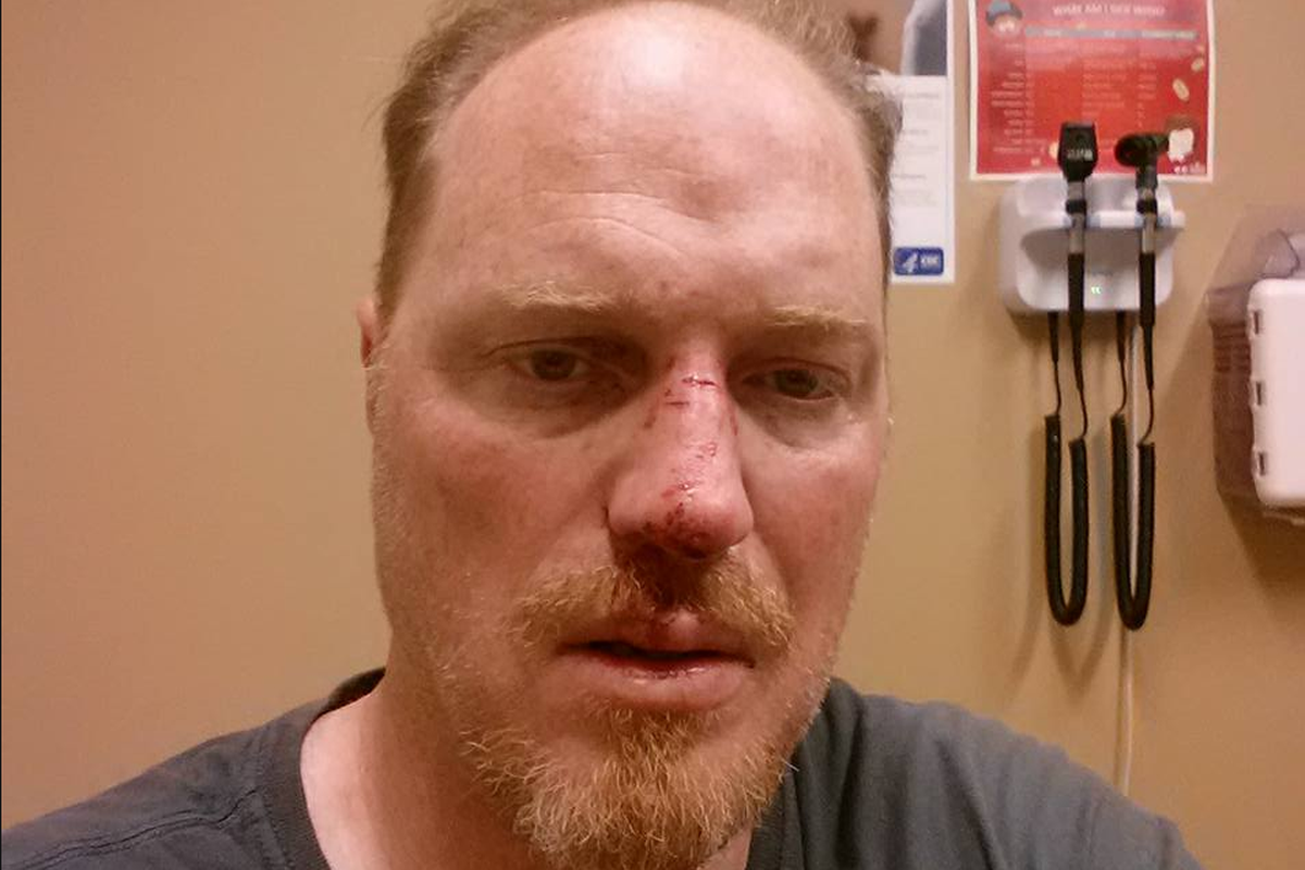 Justin Haller, showing the injuries from his collision with Virginia Pearsall, from his Facebook page.