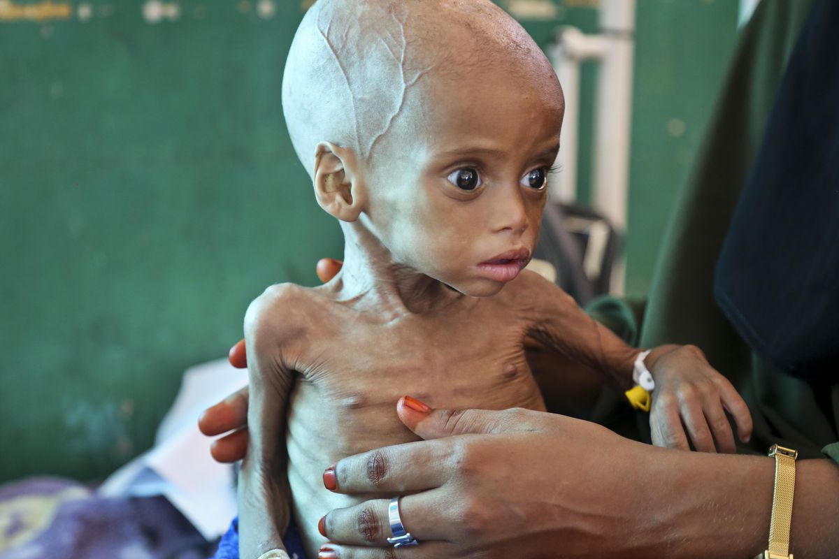 In this March 11 photo, acutely malnourished child Sacdiyo Mohamed, 9 months old, is treated at the Banadir Hospital after her mother, Halima Hassan Mohamed, fled the drought in southern Somalia and traveled by car to the capital Mogadishu, in Somalia. (Mohamed Sheikh Nor / Associated Press)