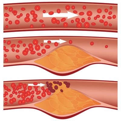 Atherosclerosis, or the narrowing of the arteries. (Tribune News Service)