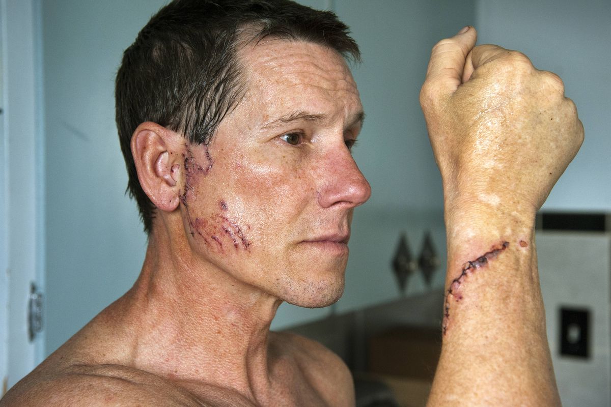 Craig Randleman, 50, suffered dog bites requiring 40 stitches on his wrist, ear and bicep, along with a swollen hand, after fighting off a pit bull that was mauling an 8-year-old girl on Thursday in Spokane. Randleman heard the screams and rushed down his alley to help. (Dan Pelle)