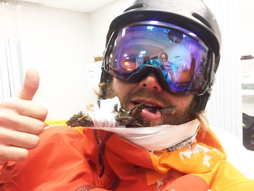 Natty Hagood, 29, a ski instructor for Jackson Hole Mountain Resort in Wyoming, impaled his face on a branch while trying to jump between two trees. (Courtesy)