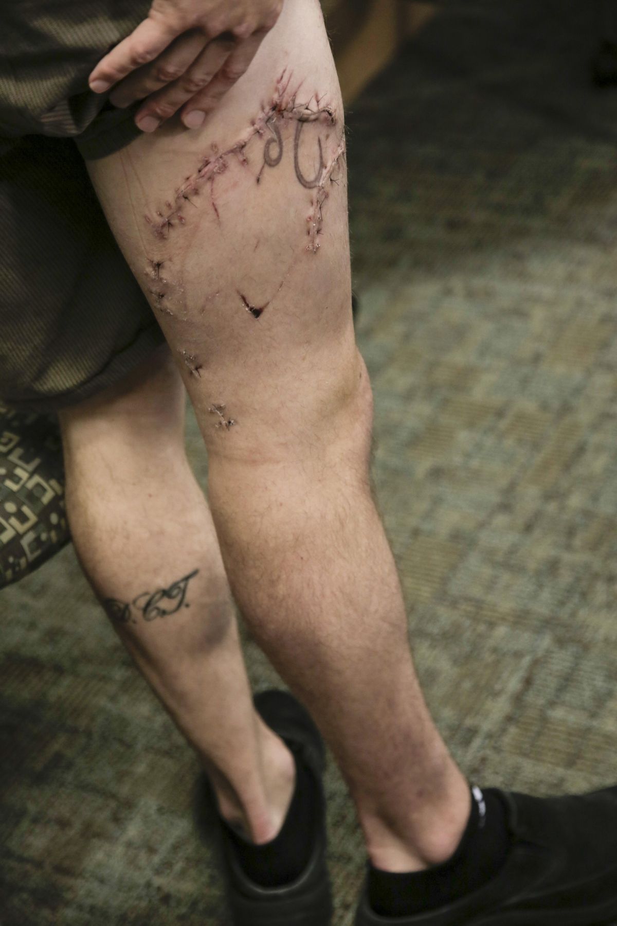 Joseph Tanner exhibits his still-healing injuries after he survived a shark attack while surfing on the Oregon Coast on Oct. 10. He spoke with media Wednesday at Portland’s Legacy Emanuel Medical Center, where he is a critical care nurse. (Stephanie Yao Long / AP)