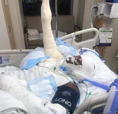 Timiyah Landers, 12, is pictured in intensive care after reportedly setting herself on fire as part of the viral “fire challenge,” in which people cover themselves in rubbing alcohol and set themselves on fire. (Courtesy photo)