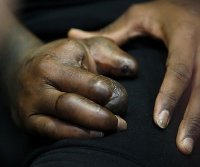 The hands of New York Giants defensive end Jason Pierre-Paul are seen as he speaks to reporters for the first time since injuring his right hand, in East Rutherford, N.J. (Julio Cortez / Associated Press)