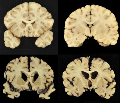 This combination of photos shows sections from a normal brain, top, and from the brain of former University of Texas football player Greg Ploetz, bottom, in stage IV of chronic traumatic encephalopathy. (Ann McKee, MD / Boston University)