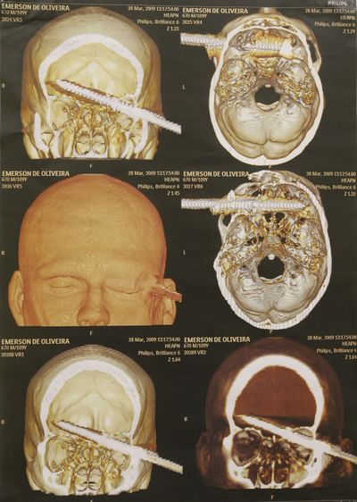 ORG XMIT: RMC108 The CAT scan of Emerson de Oliveira Abreu, a man who came to the hospital with a spear stuck in his head after a diving accident, is shown on a monitor at the Adao Pereira Nunes state hospital in Duque de Caxias, Brazil, Wednesday, April 1, 2009.  After doctors surgically removed the 6-inch (15-centimeter) spear from his brain, Abreu is in stable condition. (AP Photo/Ricardo Moraes) (Ricardo Moraes / The Spokesman-Review)
