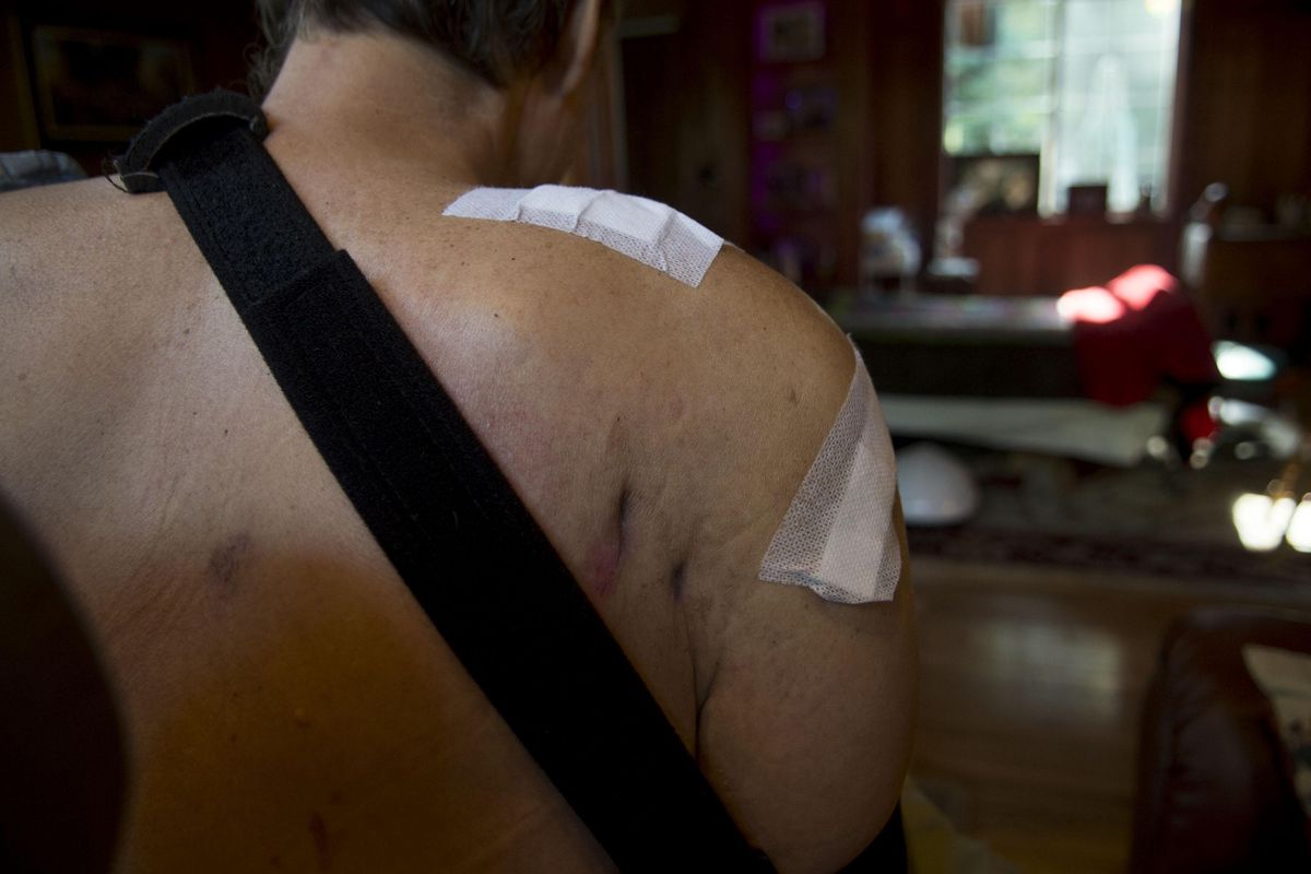 Pastor Tim Remington shows the scars left by the bullets that entered his body on March 6, 2016, as he left the Altar Church in Coeur d’Alene. “It