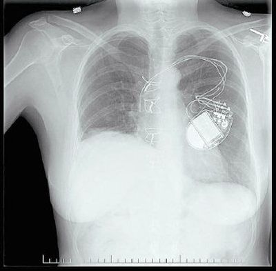 
The heart of a 30-something Northwest man beats in the chest of Kathy Cochran. The device shown is a defibrillator. 
 (Courtesy of Sacred Heart Medical Center / The Spokesman-Review)