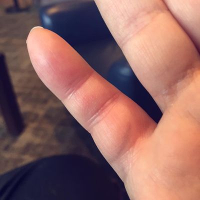 Katrina Swaim's pinky finger from her Facebook wall.