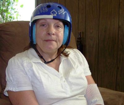 In this August 2013 photo, Yvonne Wallis, of Bayview, wears a helmet to protect her brain from further injury, after being victimized by a hammer attack on Dec. 19, 2010. (Herb Huseland/Bay Views blog photo)