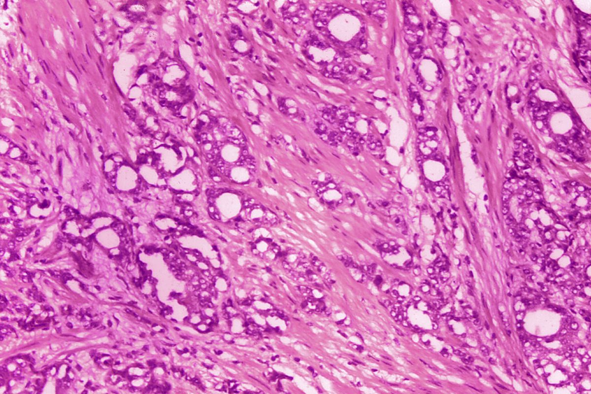 This 1974 microscope image made available by the Centers for Disease Control and Prevention shows changes in cells indicative of adenocarcinoma of the prostate. In results released Thursday, June 3, 2021 by the American Society of Clinical Oncology, doctors are reporting improved survival in men with advanced prostate cancer from an experimental drug that delivers radiation directly to tumor cells. (Edwin P. Ewing, Jr.)