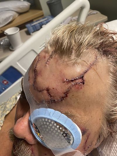 This May 18, 2021, photo, provided by Allen Minish shows lacerations on Minish's head as he recuperates at a hospital in Anchorage, Alaska, following a mauling by a brown bear. The bear charged Minish after a chance encounter in a wooded area near Gulkana, Alaska, and he estimated the encounter lasted less than 10 seconds.  (Allen Minish)