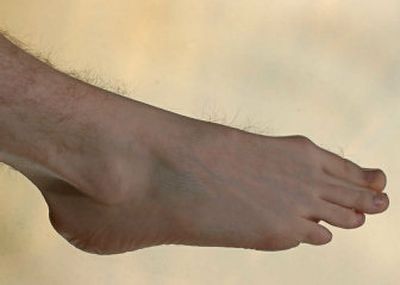
Plantar fasciitis is caused when the fibrous band of tissue that runs along the bottom of the foot  becomes torn or inflamed.
 (Associated Press / The Spokesman-Review)