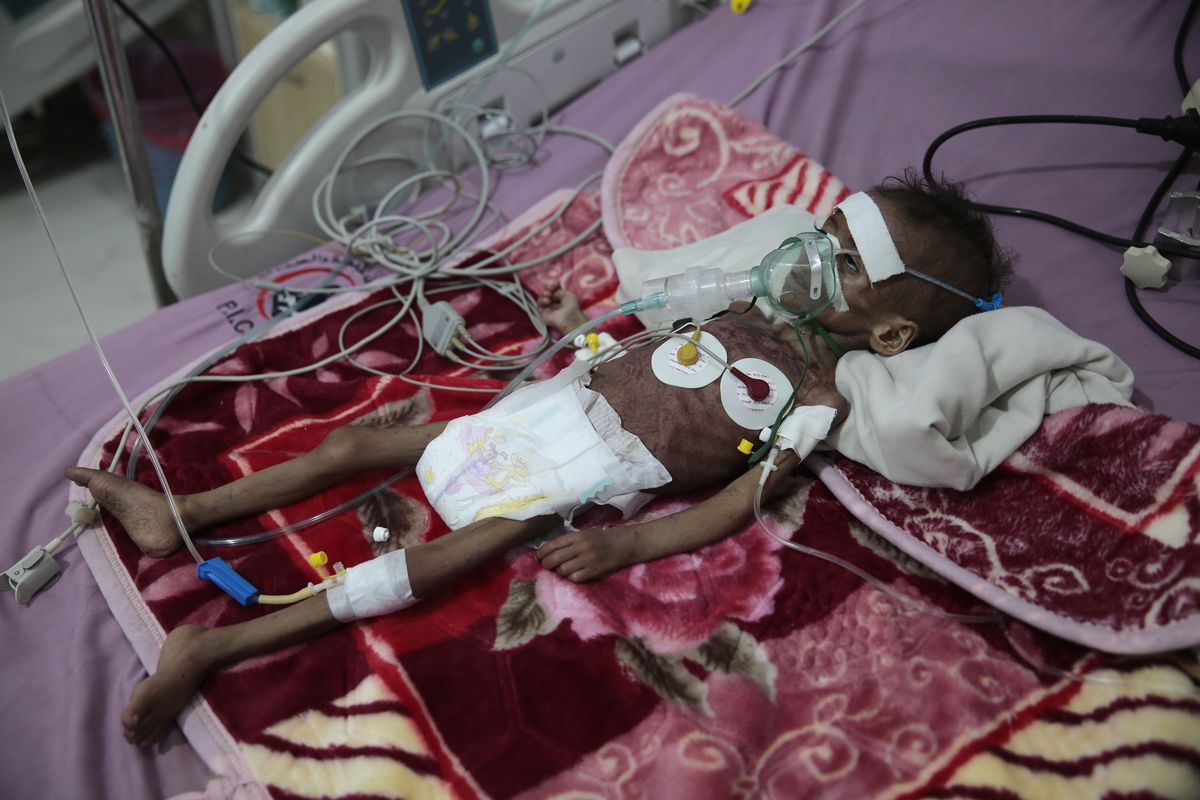 A malnourished girl Rahmah Watheeq receives treatment at a feeding center at Al-Sabeen hospital in Sanaa, Yemen, Tuesday. Nov. 3, 2020. Two-thirds of Yemen