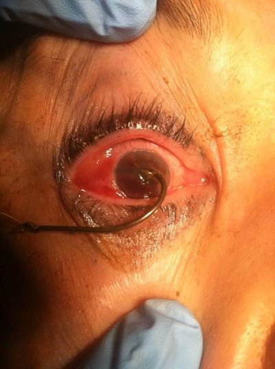 Treatment begins for a fishing hook sunk into an eye. (Fishing Eastern Washington)