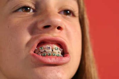 
Kids who indulge in sticky treats on Halloween often find themselves sitting in the orthodontist's chair the next day.  StockXpert
 (StockXpert / The Spokesman-Review)