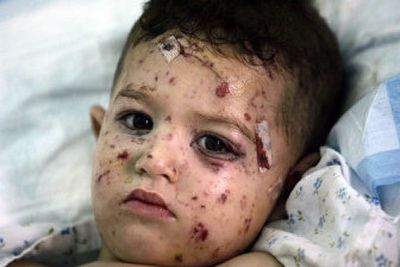 
Two-and-a-half-year-old Karib Kubaisi, wounded during an Israeli  missile attack on the village of Zebdine in southern Lebanon, rests in a hospital bed Sunday. 
 (Associated Press / The Spokesman-Review)