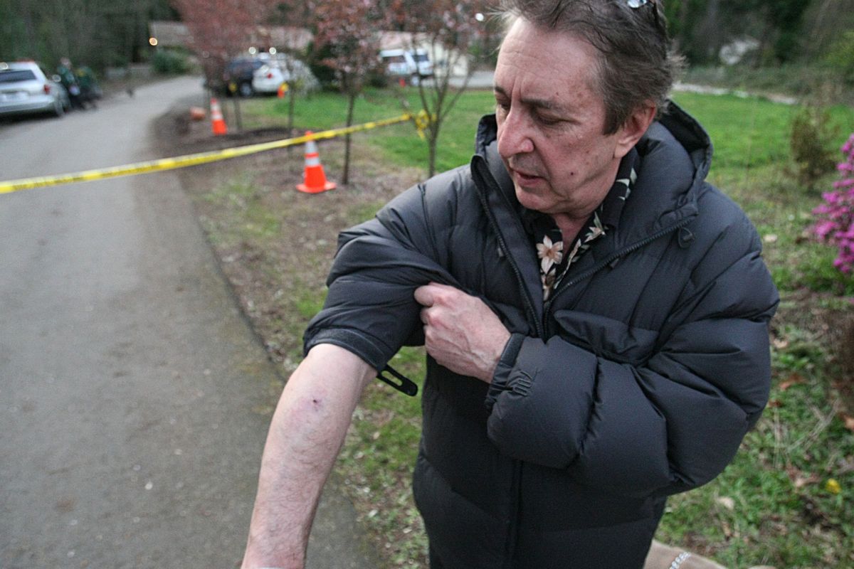 Steve Sarich, a medical marijuana advocate with a legal grow operation in his home, displays wounds he received during an attempted robbery at his home in Kirkland on Monday, March 15, 2010. Sarich returned fire and critically wounded one of the robbers. (Thom Weinstein / Seattlepi.com)